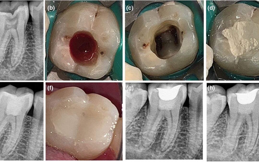 Pulpotomy in mature permanent teeth: a new era of minimally invasive endodontics