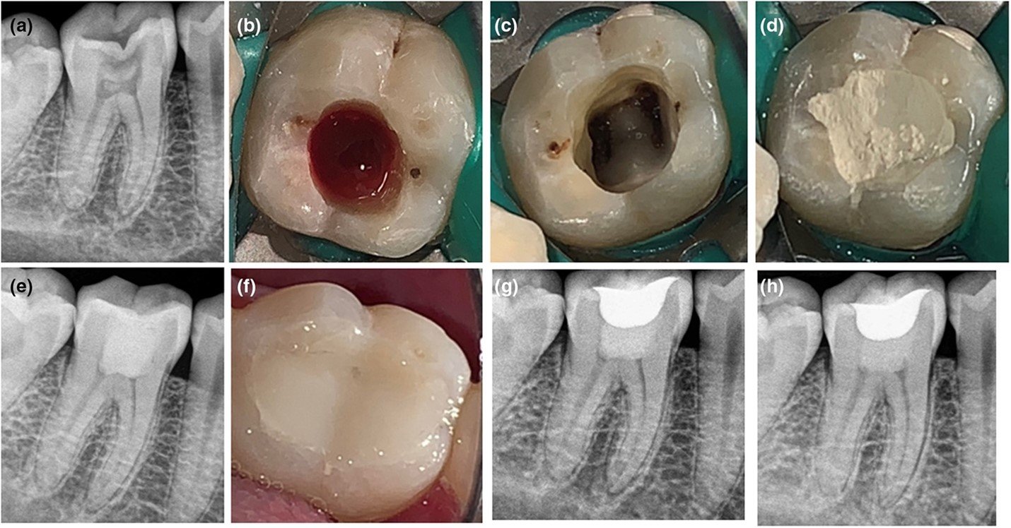 Pulpotomy in mature permanent teeth: a new era of minimally invasive endodontics