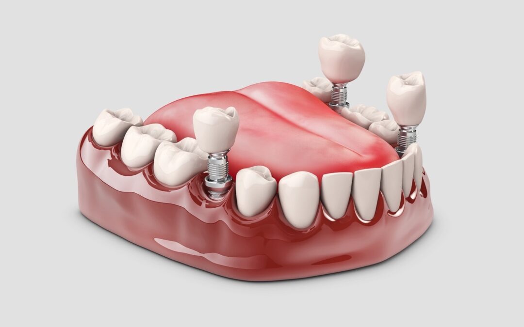 Does grafting and attached gingiva increase the success rate of implant?