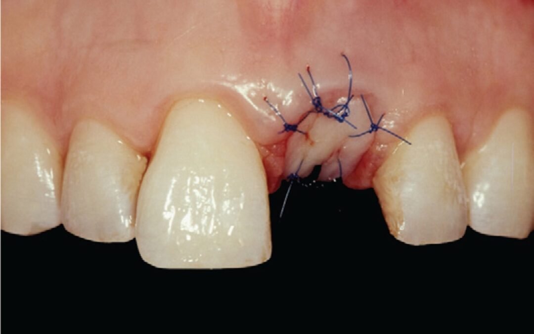 The pros and cons of socket sealing in ridge preservation – latest JCP Digest